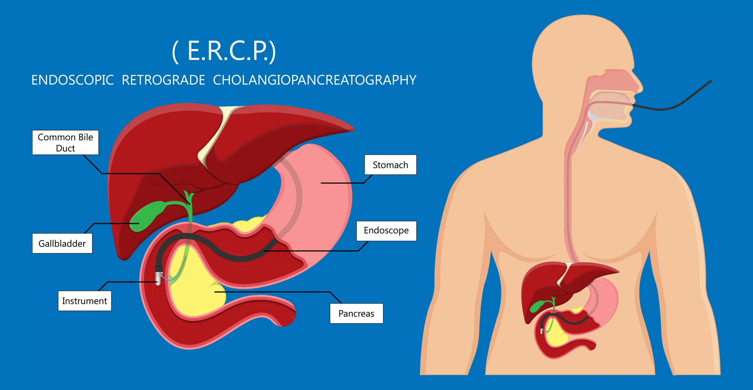 What is ERCP